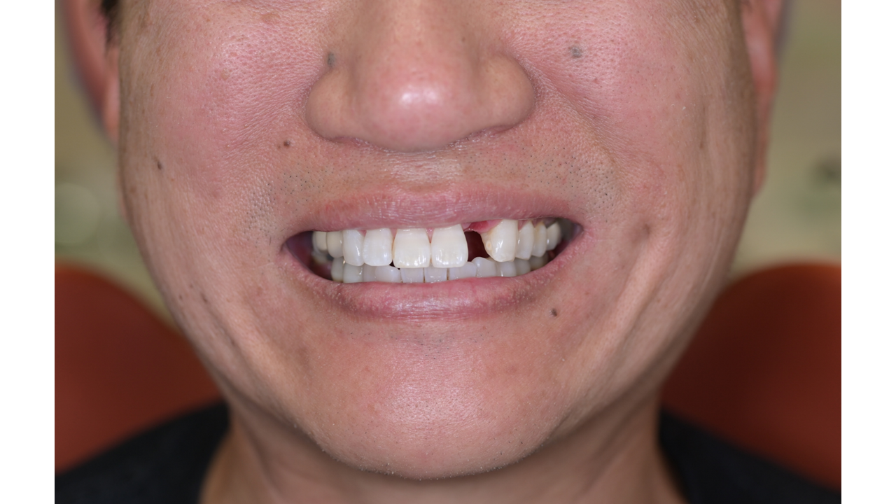Before