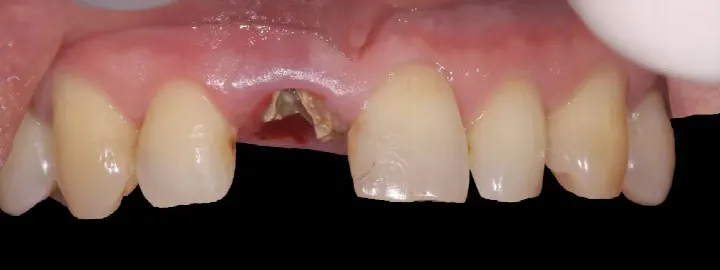 前歯の外傷による歯牙破折|抜歯即時インプラントによる審美再建 Immediate Implant & Esthetic Reconstruction|鎌倉・藤沢(治療前)