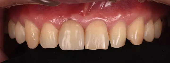 前歯の外傷による歯牙破折｜抜歯即時インプラントによる審美再建 Immediate Implant & Esthetic Reconstruction｜鎌倉・藤沢（治療後）