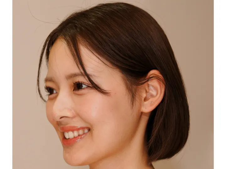 出っ歯・ガミースマイルを改善した20代の症例|アンカースクリュー併用のワイヤー矯正 鎌倉 藤沢(治療後)